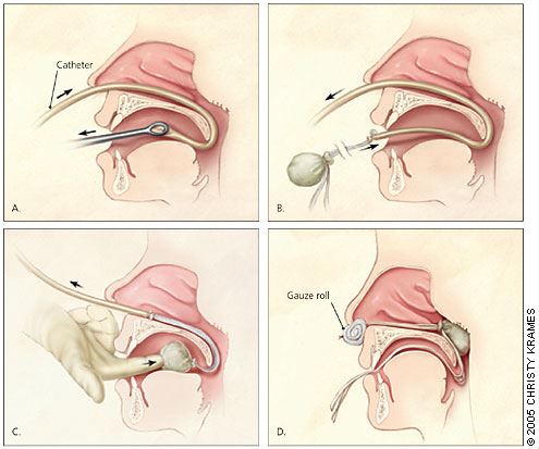 Ayurveda Epistaxis and Homoeopathy Treatments Melbourne